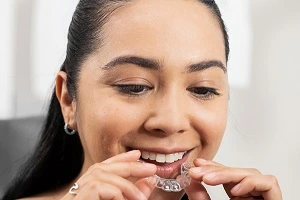 Clear Aligners