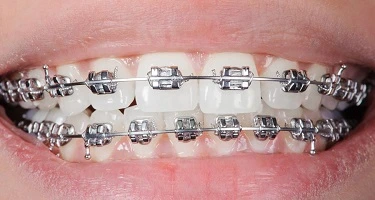 Metal Braces